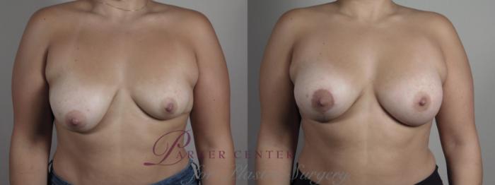 Breast Asymmetry Case 1012 Before & After Front | Paramus, NJ | Parker Center for Plastic Surgery