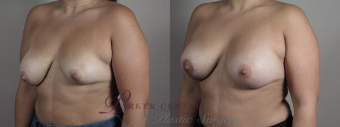 Breast Asymmetry Case 1012 Before & After Right Oblique | Paramus, NJ | Parker Center for Plastic Surgery