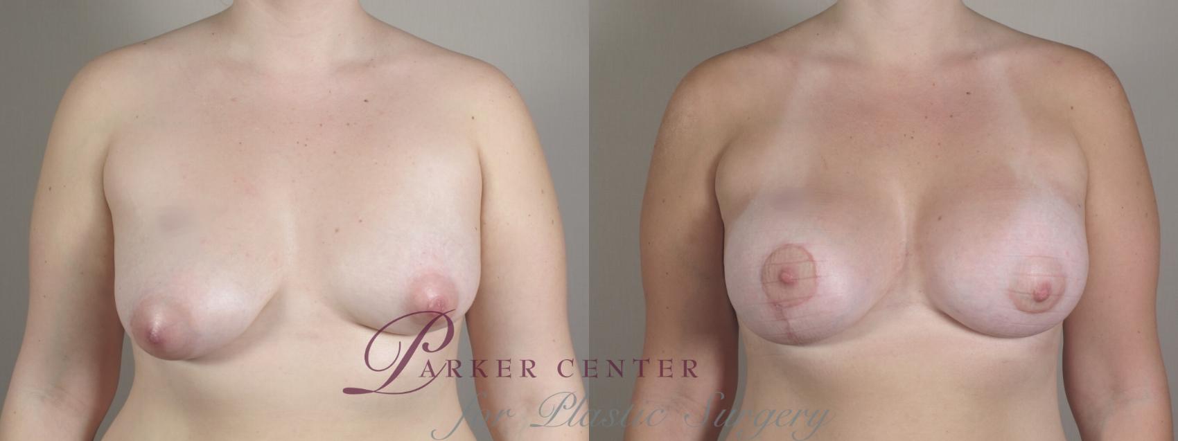 Breast Asymmetry Case 1021 Before & After Front | Paramus, NJ | Parker Center for Plastic Surgery