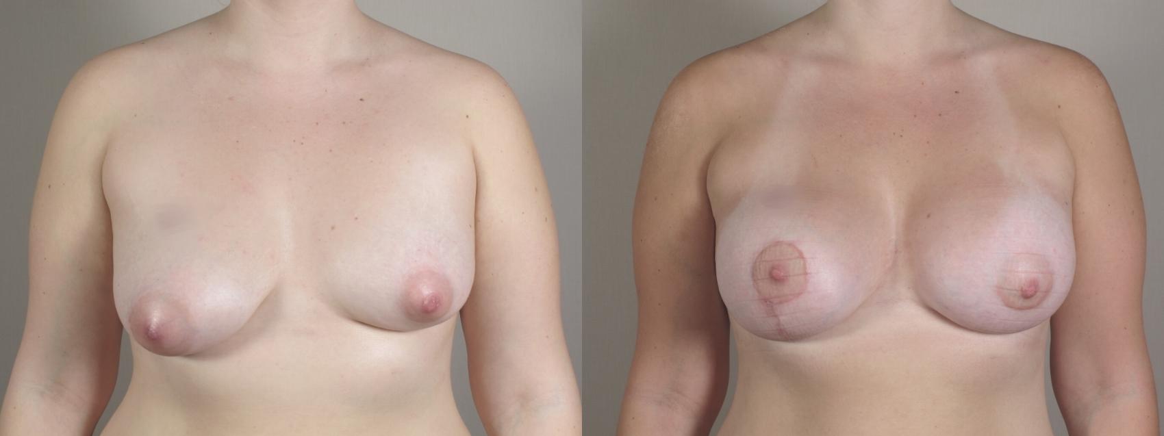 Breast Asymmetry Case 1021 Before & After Front | Paramus, NJ | Parker Center for Plastic Surgery