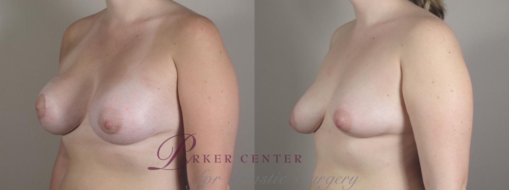 Breast Asymmetry Case 1021 Before & After Right Oblique | Paramus, NJ | Parker Center for Plastic Surgery