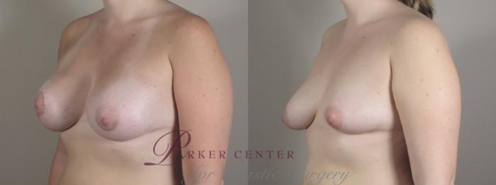 Breast Asymmetry Case 1021 Before & After Right Oblique | Paramus, NJ | Parker Center for Plastic Surgery