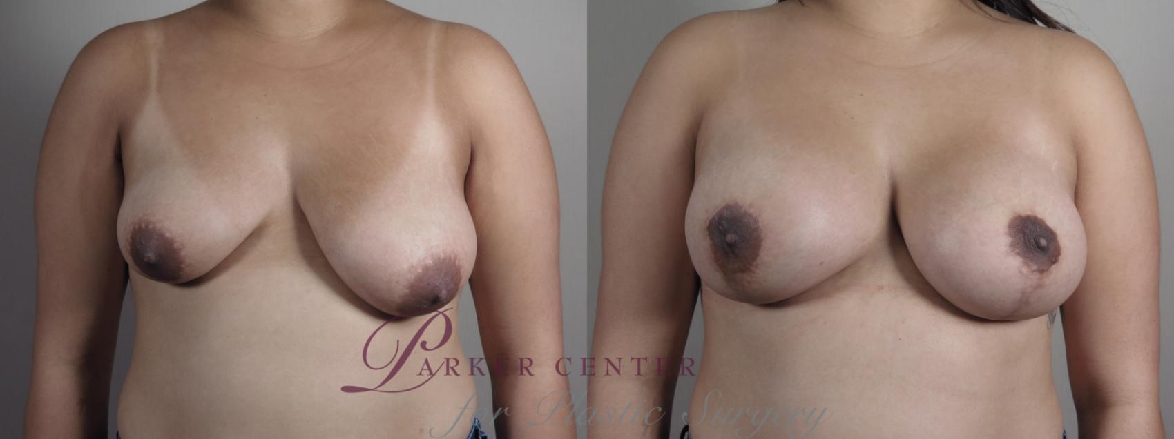 Breast Asymmetry Case 1023 Before & After Front | Paramus, NJ | Parker Center for Plastic Surgery