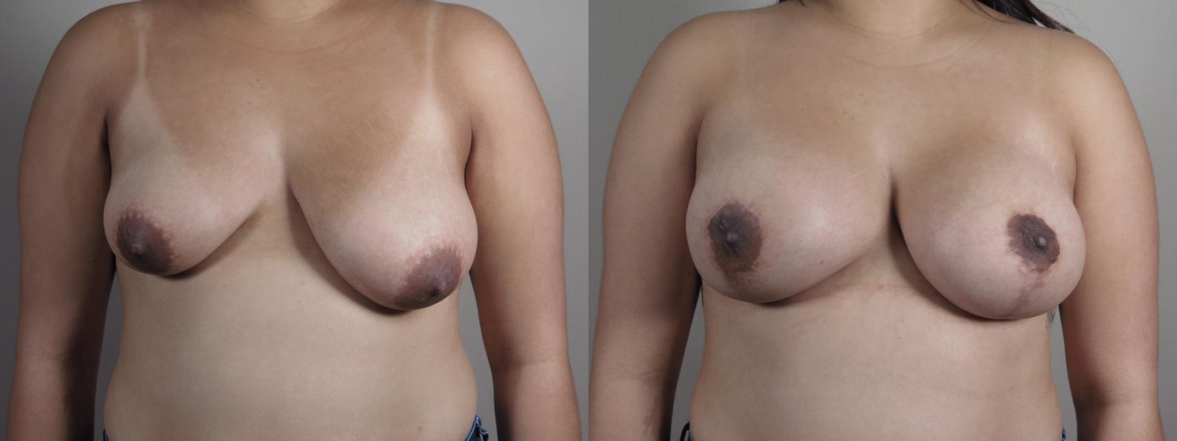 Breast Asymmetry Case 1023 Before & After Front | Paramus, New Jersey | Parker Center for Plastic Surgery