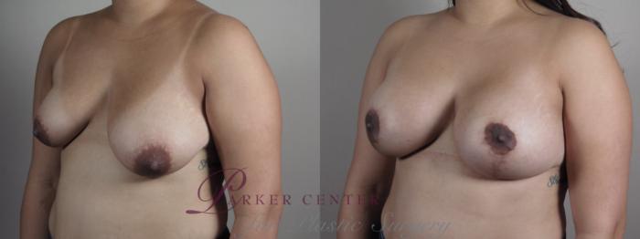 Breast Asymmetry Case 1023 Before & After Right Oblique | Paramus, NJ | Parker Center for Plastic Surgery
