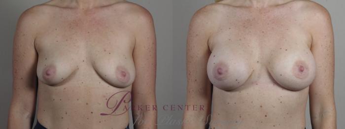 Breast Asymmetry Case 1332 Before & After Front | Paramus, NJ | Parker Center for Plastic Surgery