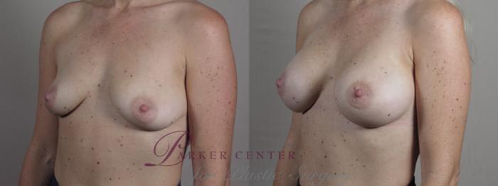 Breast Asymmetry Case 1332 Before & After Left Oblique | Paramus, NJ | Parker Center for Plastic Surgery