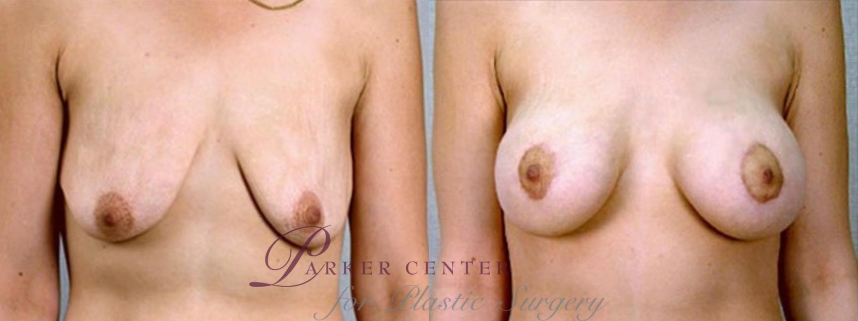 Breast Asymmetry Case 1346 Before & After Front | Paramus, NJ | Parker Center for Plastic Surgery