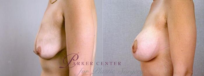 Breast Asymmetry Case 1346 Before & After Left Side | Paramus, NJ | Parker Center for Plastic Surgery