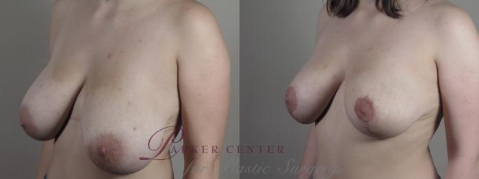 Breast Asymmetry Case 1369 Before & After Left Oblique | Paramus, NJ | Parker Center for Plastic Surgery