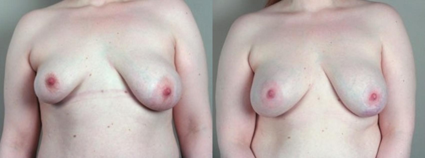 Breast Asymmetry Case 447 Before & After View #1 | Paramus, New Jersey | Parker Center for Plastic Surgery