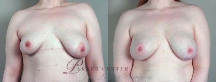 Breast Asymmetry Case 447 Before & After View #1 | Paramus, NJ | Parker Center for Plastic Surgery