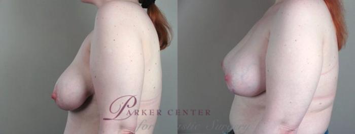 Breast Asymmetry Case 447 Before & After View #2 | Paramus, NJ | Parker Center for Plastic Surgery
