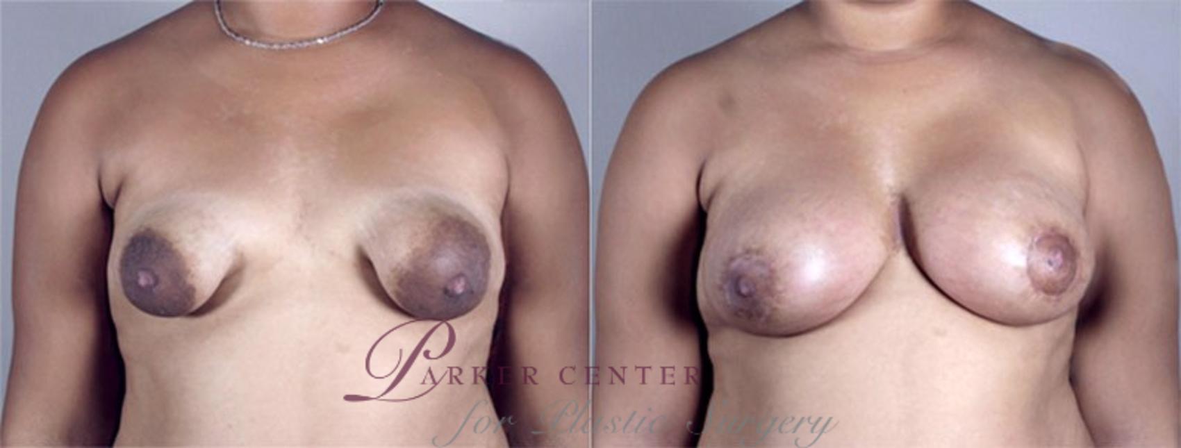 Breast Asymmetry Case 465 Before & After View #1 | Paramus, NJ | Parker Center for Plastic Surgery