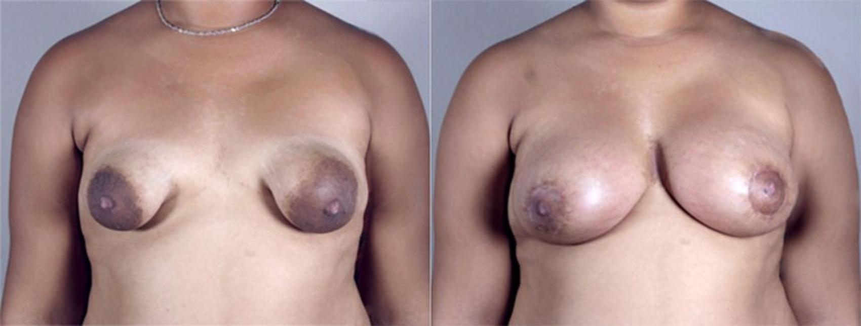 Breast Asymmetry Case 465 Before & After View #1 | Paramus, New Jersey | Parker Center for Plastic Surgery