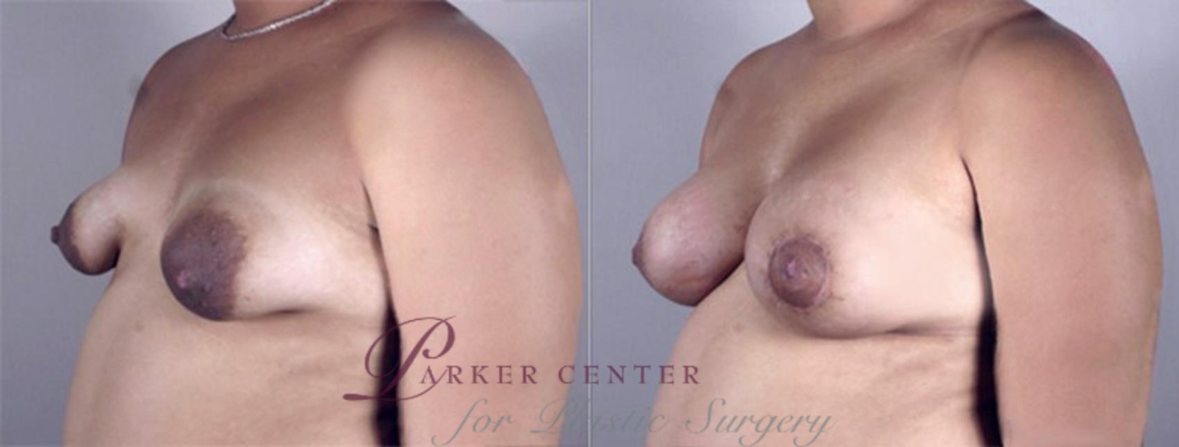 Breast Asymmetry Case 465 Before & After View #2 | Paramus, NJ | Parker Center for Plastic Surgery