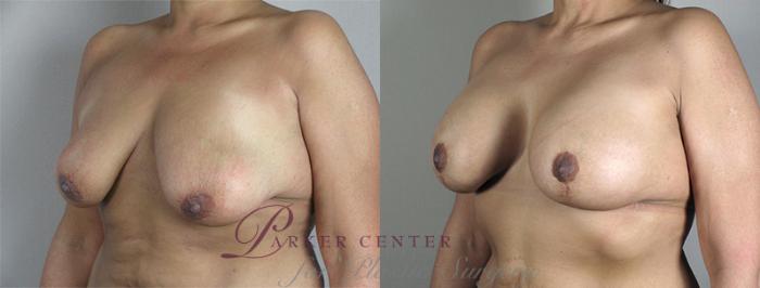 Breast Asymmetry Case 468 Before & After View #2 | Paramus, NJ | Parker Center for Plastic Surgery