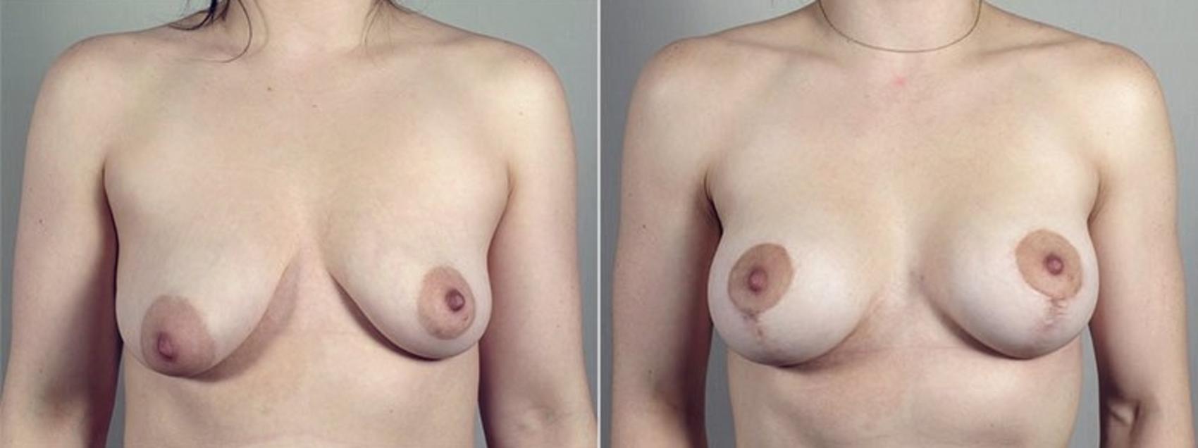 Breast Asymmetry Case 490 Before & After View #1 | Paramus, NJ | Parker Center for Plastic Surgery