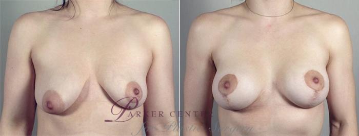 Breast Asymmetry Case 490 Before & After View #1 | Paramus, NJ | Parker Center for Plastic Surgery