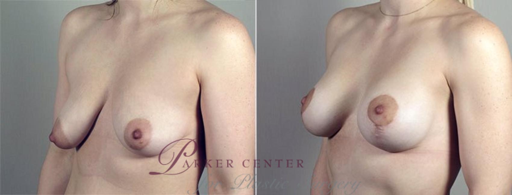Breast Asymmetry Case 490 Before & After View #2 | Paramus, NJ | Parker Center for Plastic Surgery