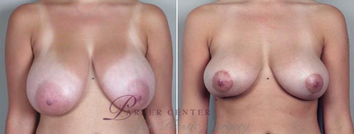 Breast Reduction Case 500 Before & After View #1 | Paramus, NJ | Parker Center for Plastic Surgery