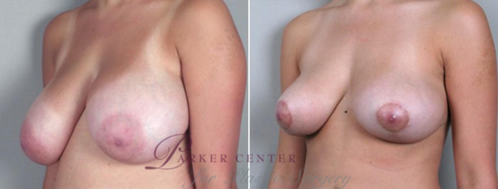 Breast Reduction Case 500 Before & After View #2 | Paramus, NJ | Parker Center for Plastic Surgery
