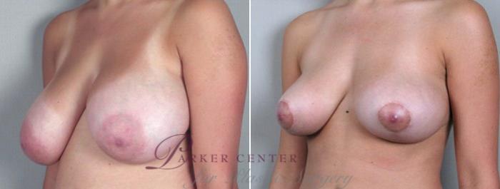 Breast Asymmetry Case 500 Before & After View #2 | Paramus, NJ | Parker Center for Plastic Surgery