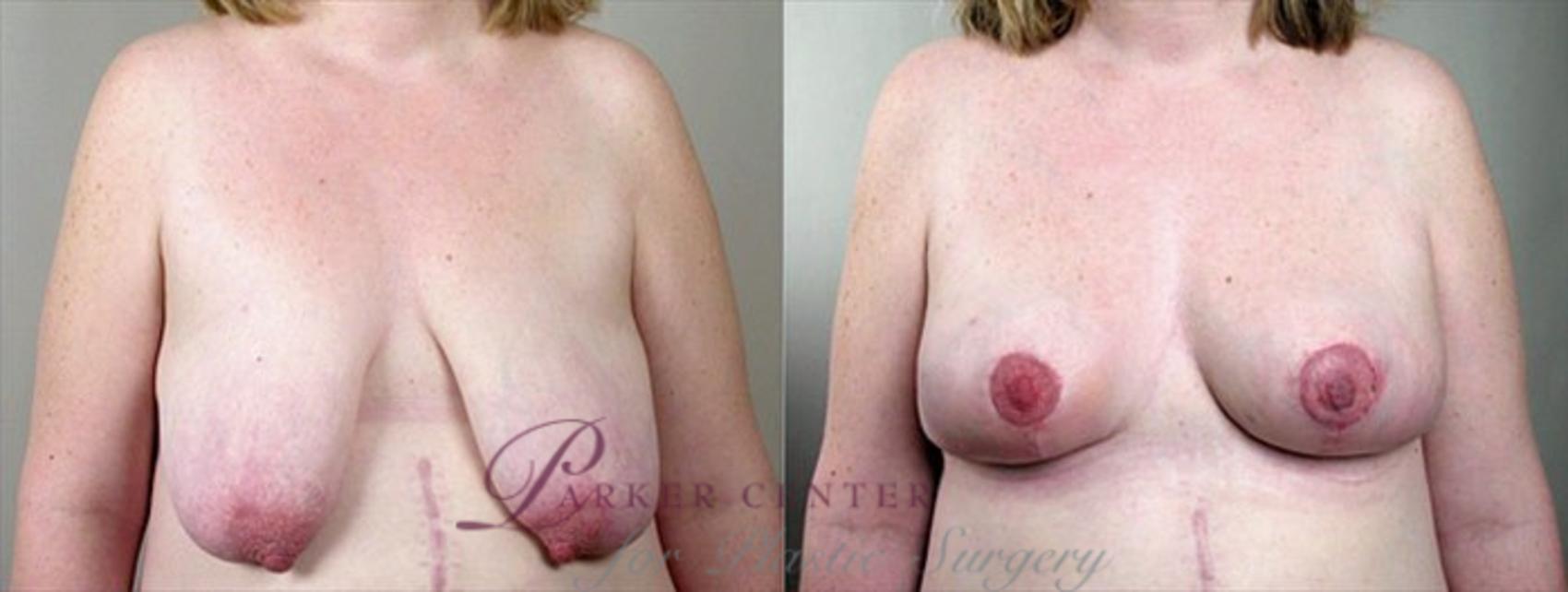 Breast Asymmetry Case 502 Before & After View #1 | Paramus, NJ | Parker Center for Plastic Surgery