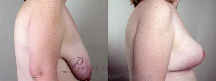 Breast Asymmetry Case 502 Before & After View #2 | Paramus, NJ | Parker Center for Plastic Surgery