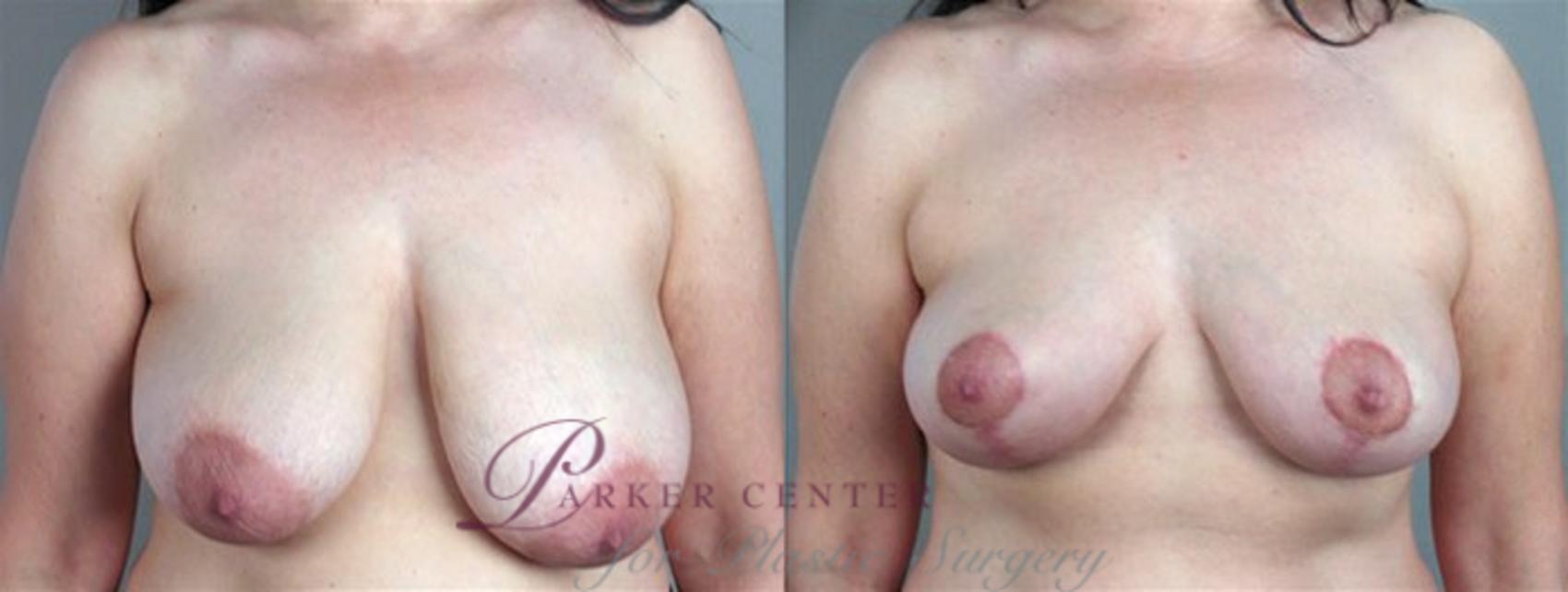 Breast Asymmetry Case 503 Before & After View #1 | Paramus, NJ | Parker Center for Plastic Surgery
