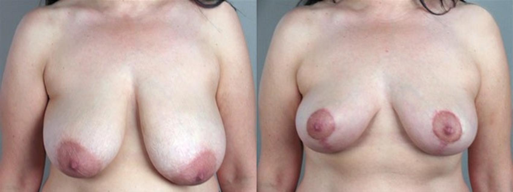 Breast Asymmetry Case 503 Before & After View #1 | Paramus, NJ | Parker Center for Plastic Surgery