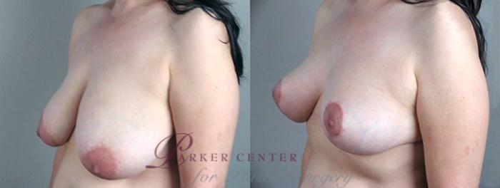 Breast Asymmetry Case 503 Before & After View #2 | Paramus, NJ | Parker Center for Plastic Surgery
