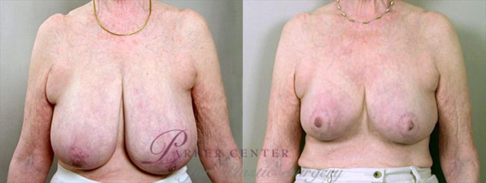 Breast Reduction Case 504 Before & After View #1 | Paramus, NJ | Parker Center for Plastic Surgery