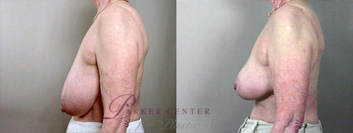 Breast Asymmetry Case 504 Before & After View #2 | Paramus, NJ | Parker Center for Plastic Surgery