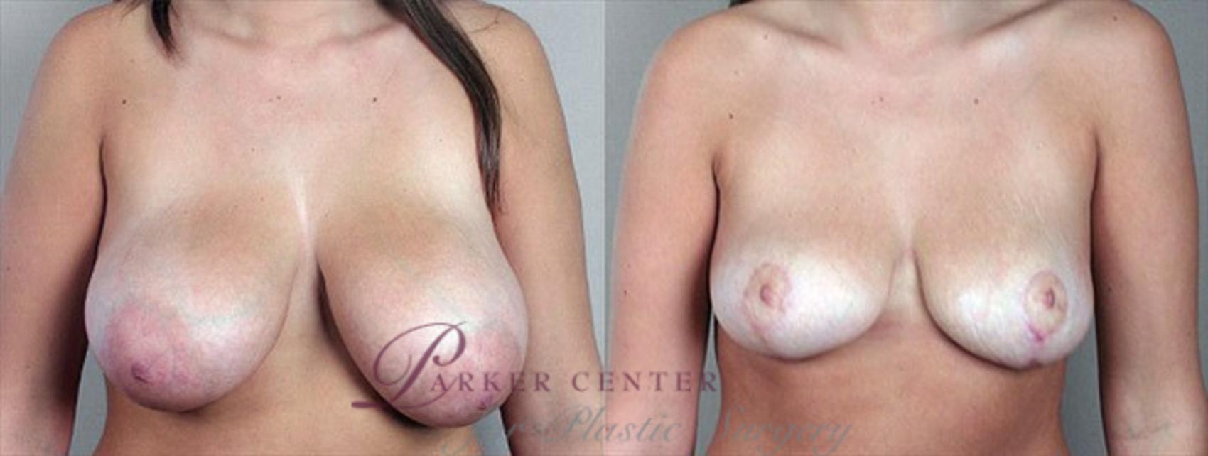 Breast Reduction Case 505 Before & After View #1 | Paramus, NJ | Parker Center for Plastic Surgery
