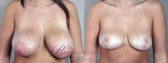 Breast Asymmetry Case 505 Before & After View #1 | Paramus, NJ | Parker Center for Plastic Surgery