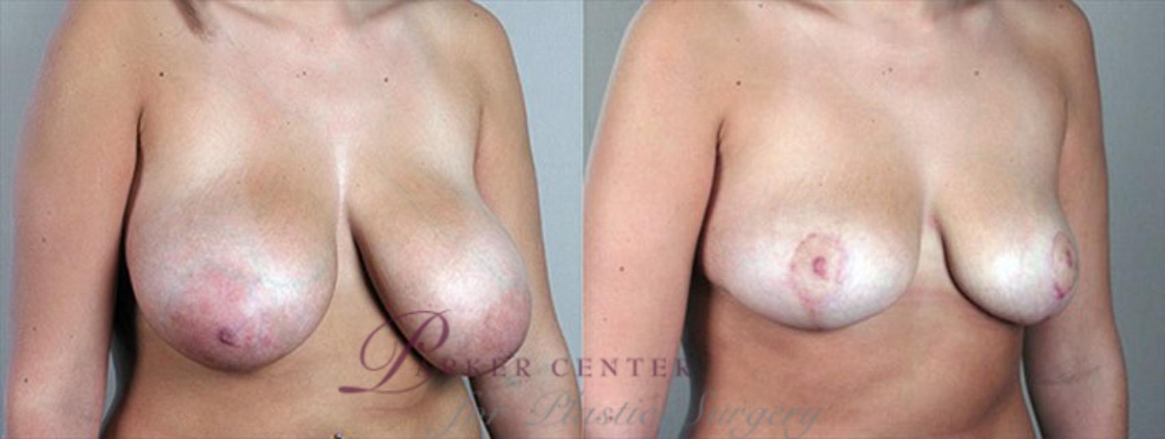 Breast Reduction Case 505 Before & After View #2 | Paramus, NJ | Parker Center for Plastic Surgery