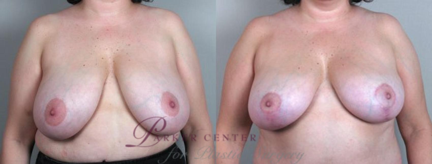 Breast Reduction Case 506 Before & After View #1 | Paramus, NJ | Parker Center for Plastic Surgery