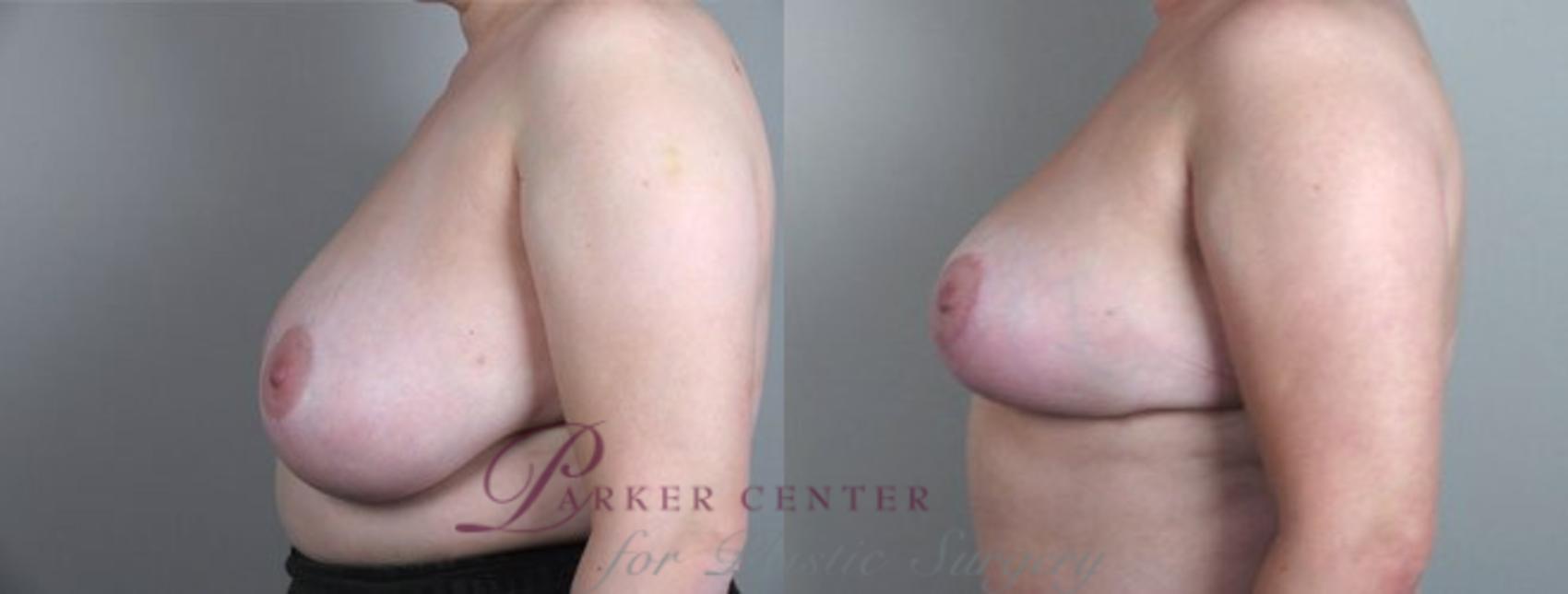 Breast Reduction Case 506 Before & After View #2 | Paramus, NJ | Parker Center for Plastic Surgery