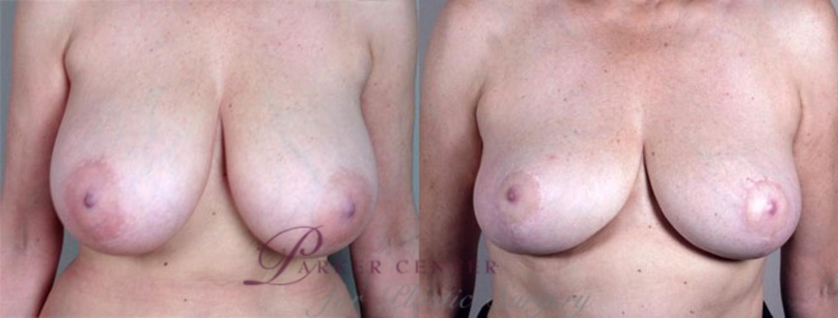 Breast Asymmetry Case 507 Before & After View #1 | Paramus, New Jersey | Parker Center for Plastic Surgery