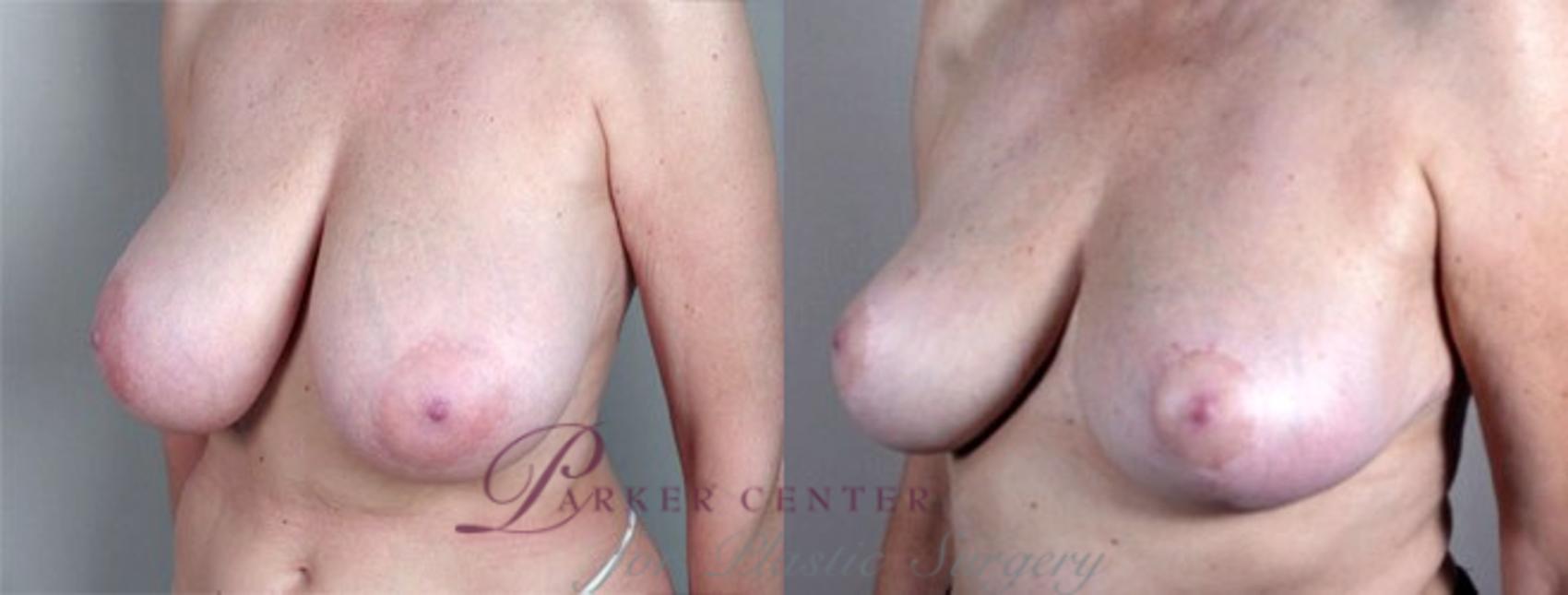 Breast Reduction Case 507 Before & After View #2 | Paramus, NJ | Parker Center for Plastic Surgery