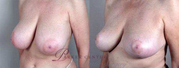 Breast Asymmetry Case 507 Before & After View #2 | Paramus, NJ | Parker Center for Plastic Surgery