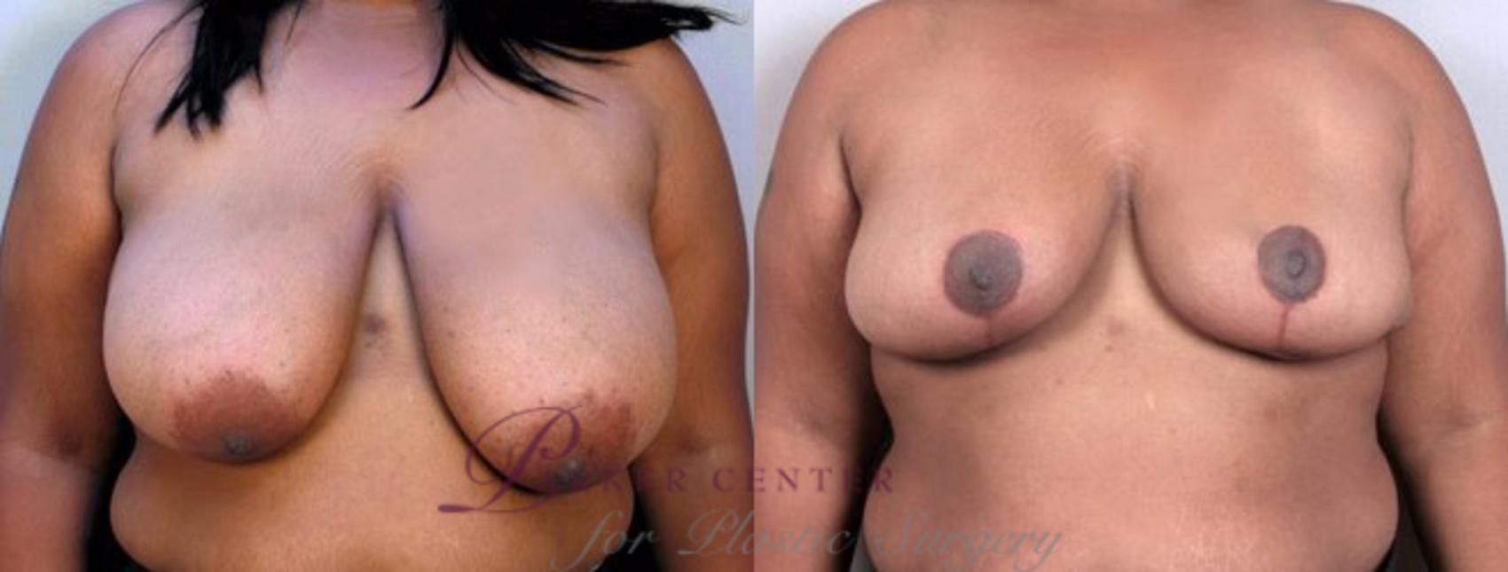 Breast Reduction Case 508 Before & After View #1 | Paramus, NJ | Parker Center for Plastic Surgery