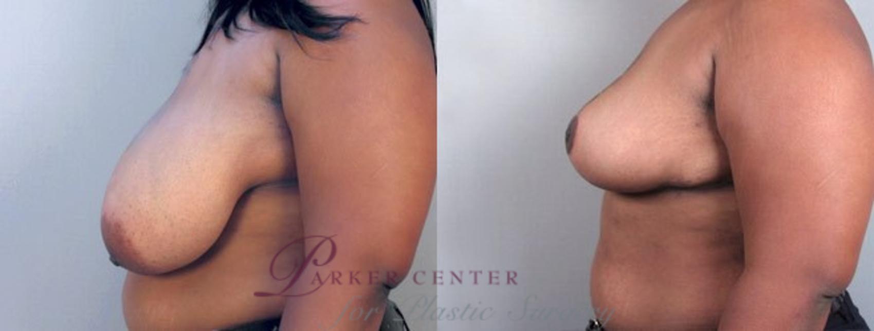 Breast Reduction Case 508 Before & After View #2 | Paramus, NJ | Parker Center for Plastic Surgery