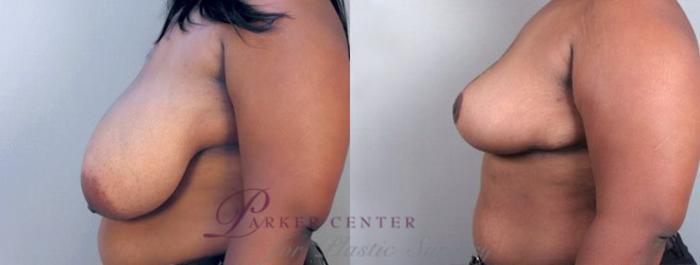 Breast Asymmetry Case 508 Before & After View #2 | Paramus, NJ | Parker Center for Plastic Surgery