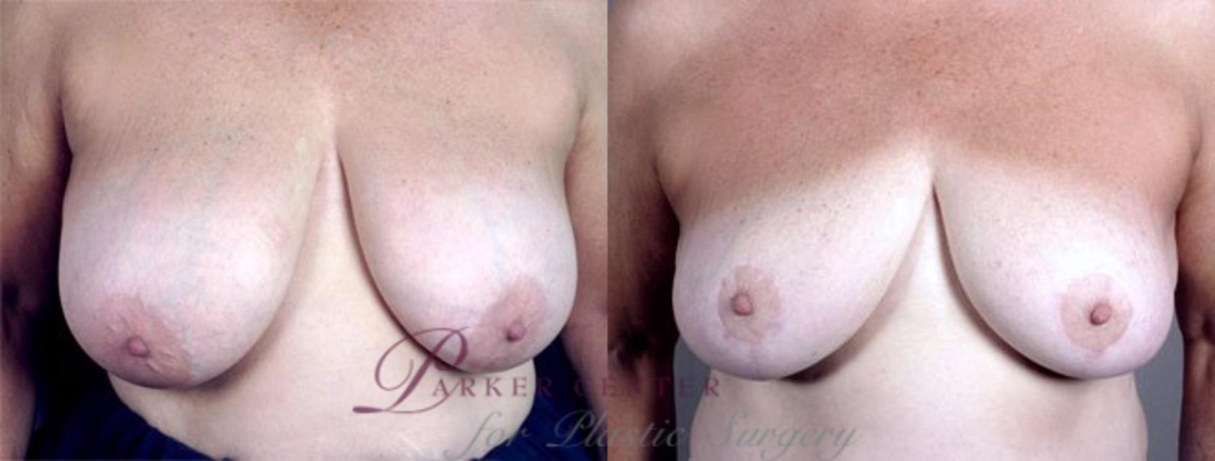 Breast Reduction Case 509 Before & After View #1 | Paramus, NJ | Parker Center for Plastic Surgery