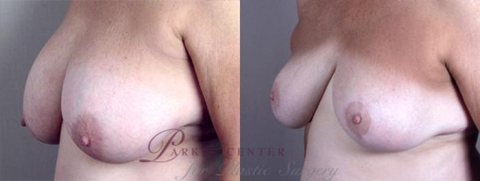Breast Asymmetry Case 509 Before & After View #2 | Paramus, NJ | Parker Center for Plastic Surgery