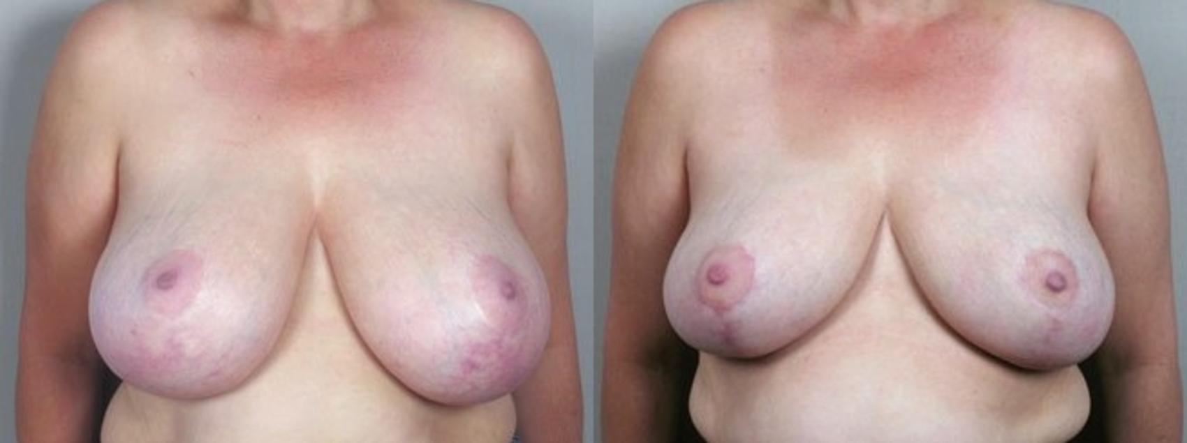 Breast Asymmetry Case 510 Before & After View #1 | Paramus, New Jersey | Parker Center for Plastic Surgery