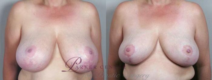 Breast Asymmetry Case 510 Before & After View #1 | Paramus, NJ | Parker Center for Plastic Surgery