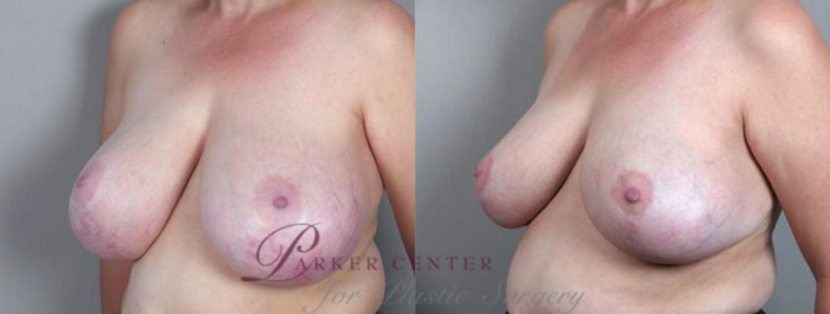 Breast Asymmetry Case 510 Before & After View #2 | Paramus, NJ | Parker Center for Plastic Surgery